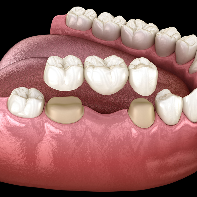 replace missing teeth with dental bridges