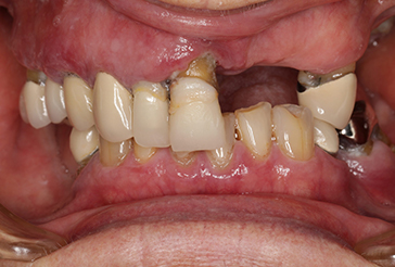 Before All on 4 Same-day teeth treatment