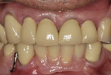 Partial Dentures, Crowns and Composite Bonding