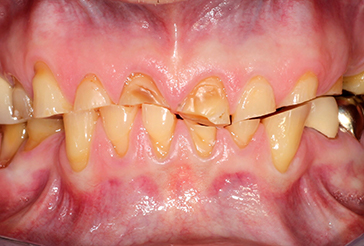 before partial dentures treatment
