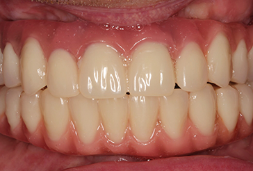 Smile Makeover using All on 4 Same-day Teeth
