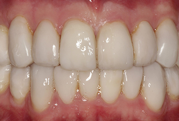 after composite bonding, onlays and crowns treatment