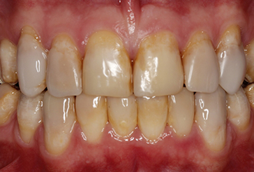 before composite bonding, onlays and crowns treatment
