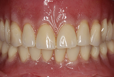 complete cosmetic dentures treatment