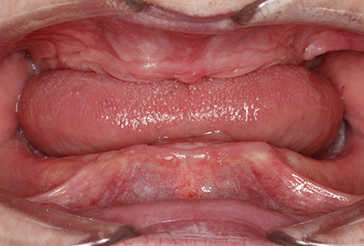 before complete cosmetic dentures photo