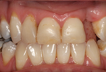 Dental Implants and Composite Bonding before
