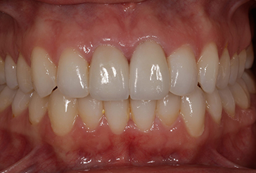 front teeth after cosmetic crowns