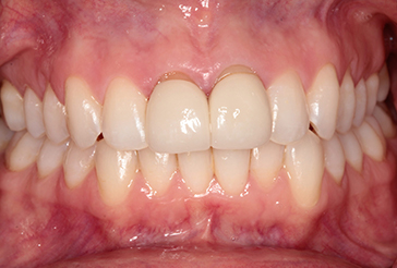 front teeth before cosmetic crowns