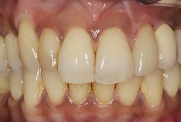 photo after dental implants and crowns